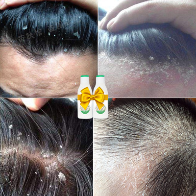 告別頭屑與瘙癢 如何選擇適合脂溢性頭皮的無硅油去螨洗發(fā)水